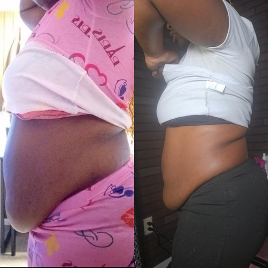 Mommy Makeover Treatment (Stomach & Sides)